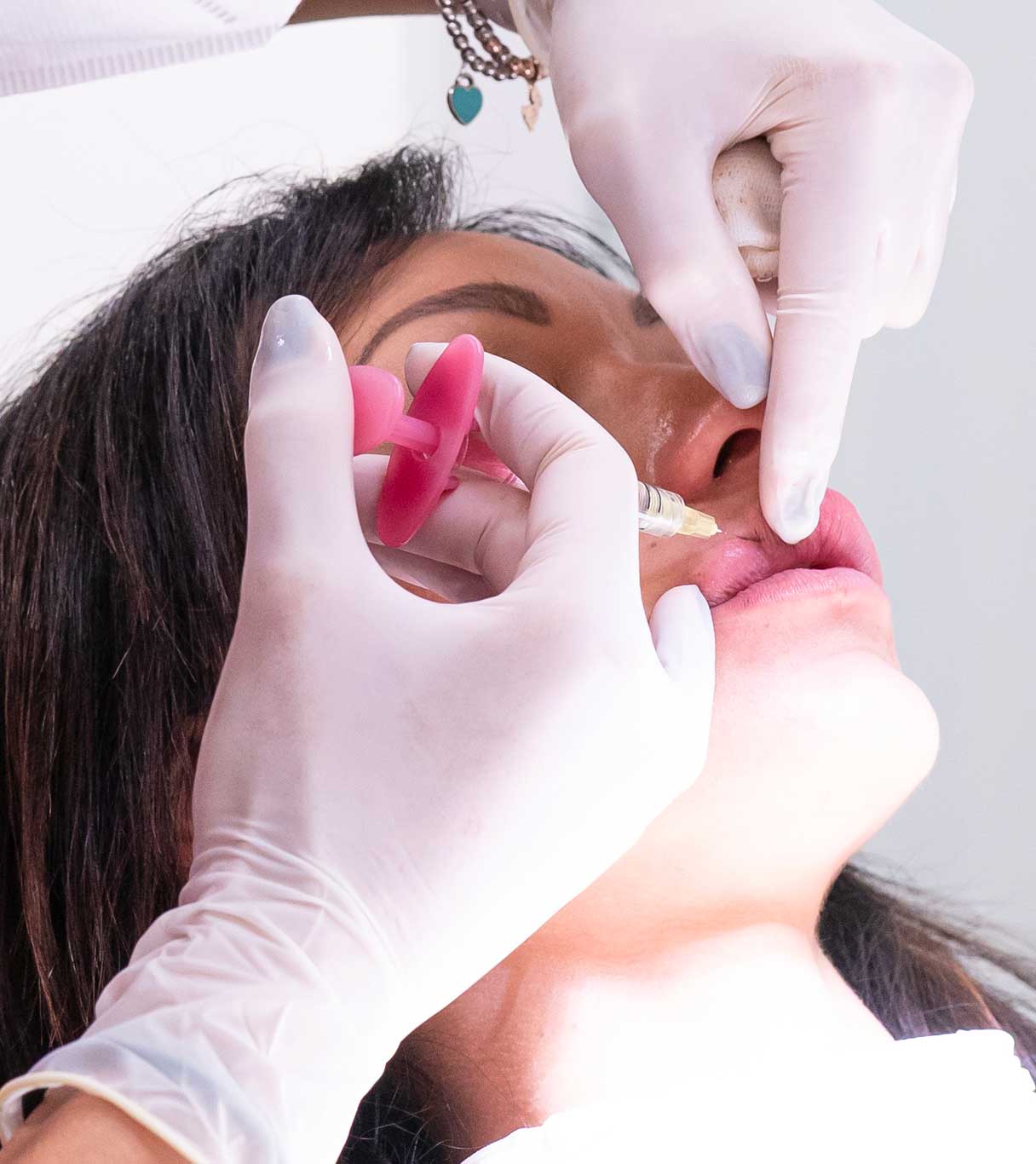Filler Labbra
